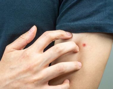 Effective Home Remedies for Bug Bites - HealThyRam - Blog
