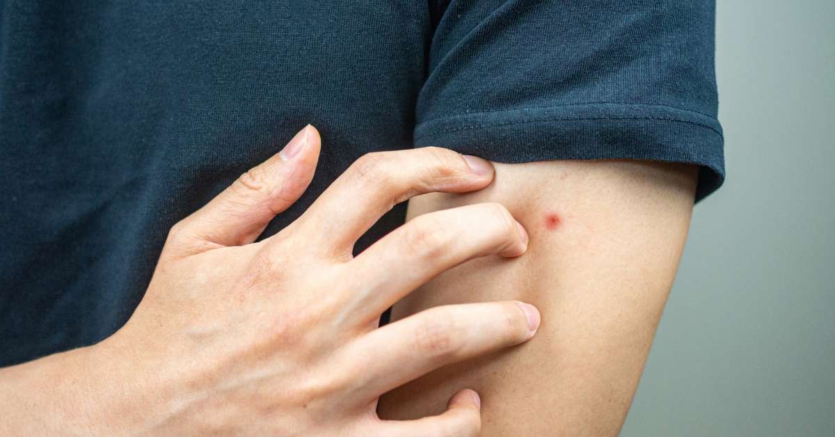 Effective Home Remedies for Bug Bites - HealThyRam - Blog